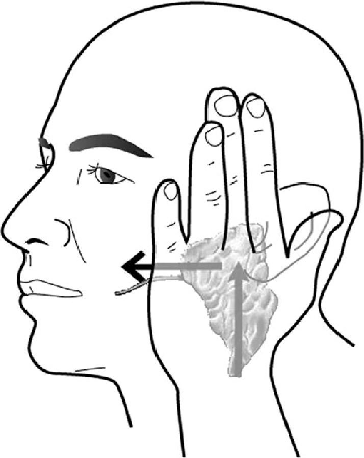 714x896 Sketch Demonstrating The Parotid Gland (Pg) Massage Method Used (3 - Massage Sketch