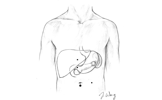 650x400 Laparoscopic Surgery - Pancreas Sketch