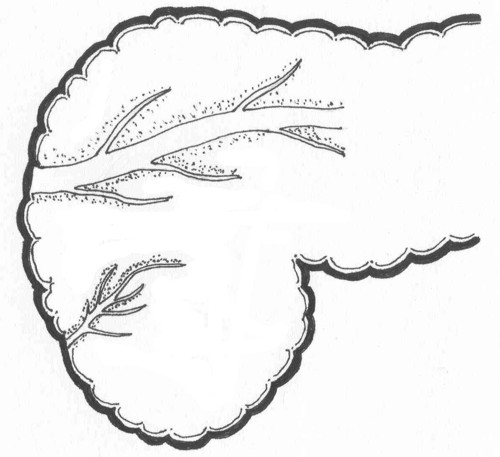 500x457 Bhasin Dk, Et Al. Ansa Pancreatica Type Of Ductal Anatomy In A - Pancreas Sketch