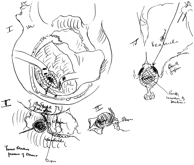750x640 Sketch Showing The Operative Findings For Transfrontal - Patient Sketch
