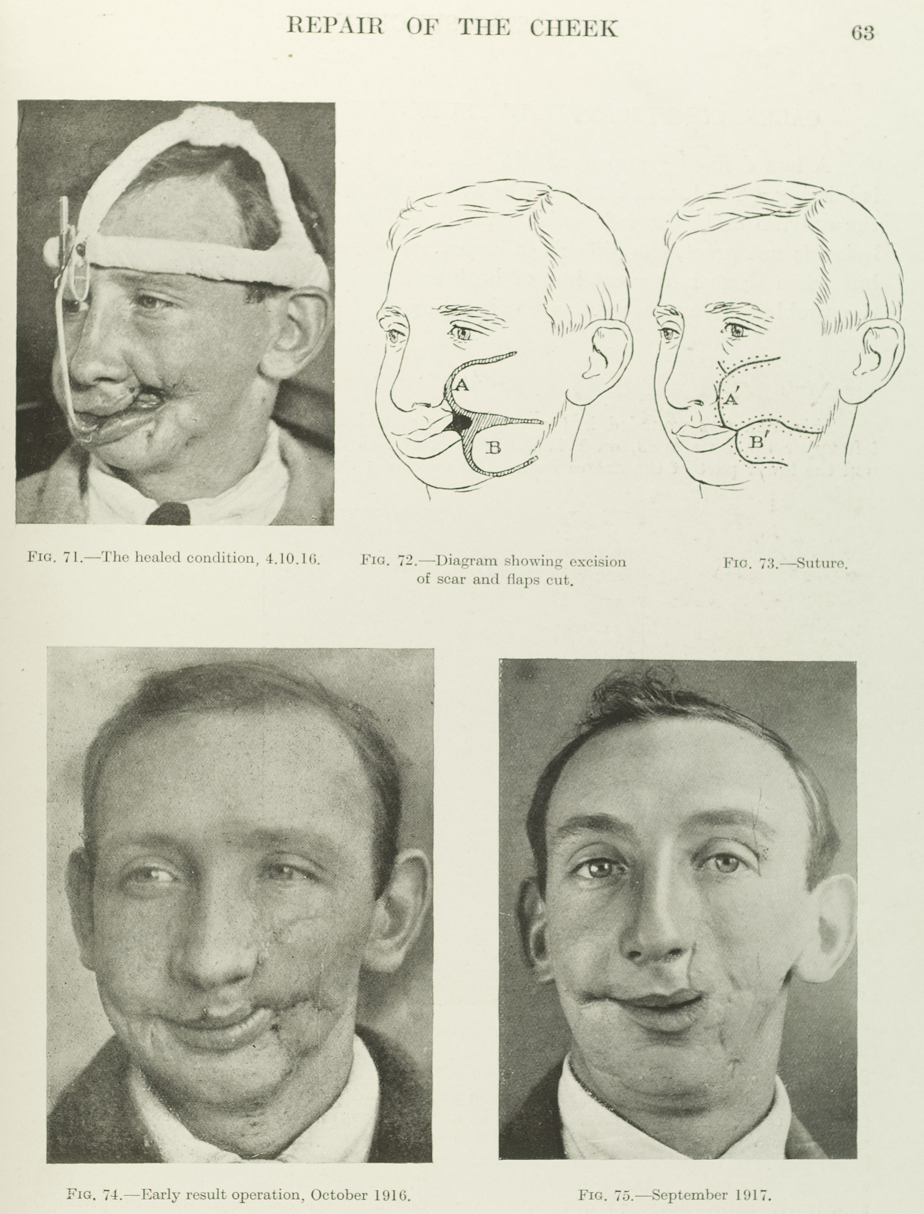3209x4214 Filephotographs And Diagrams Showing Plastic Surgery To The Face - Plastic Surgery Sketch