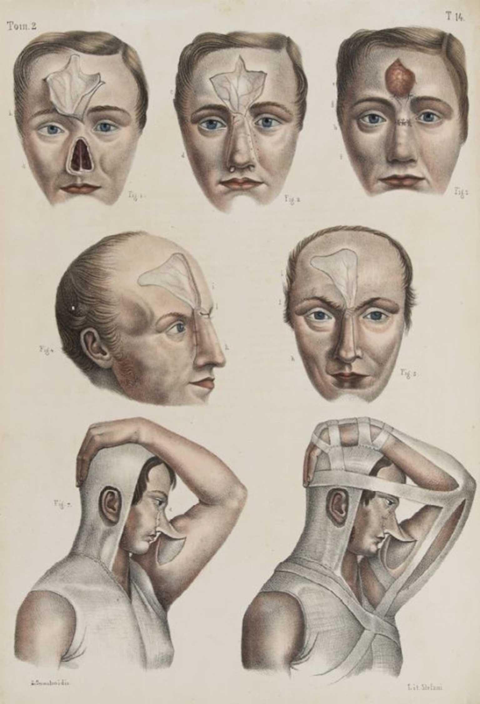 1536x2251 The Ugly History Of Cosmetic Surgery The Independent - Plastic Surgery Sketch