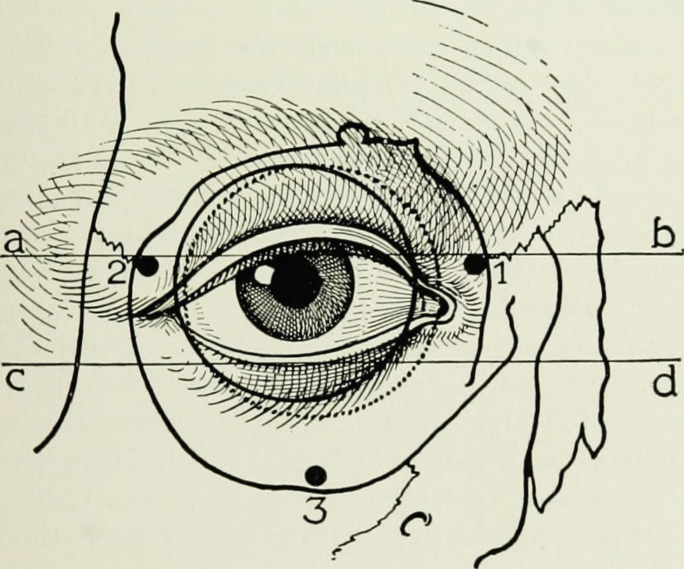 978x814 8.4.14 Ethnic Plastic Surgery, The Mysterious Placenta Amp The - Plastic Surgery Sketch