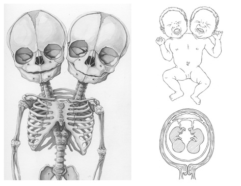 Horrorporn - Siamese Twins