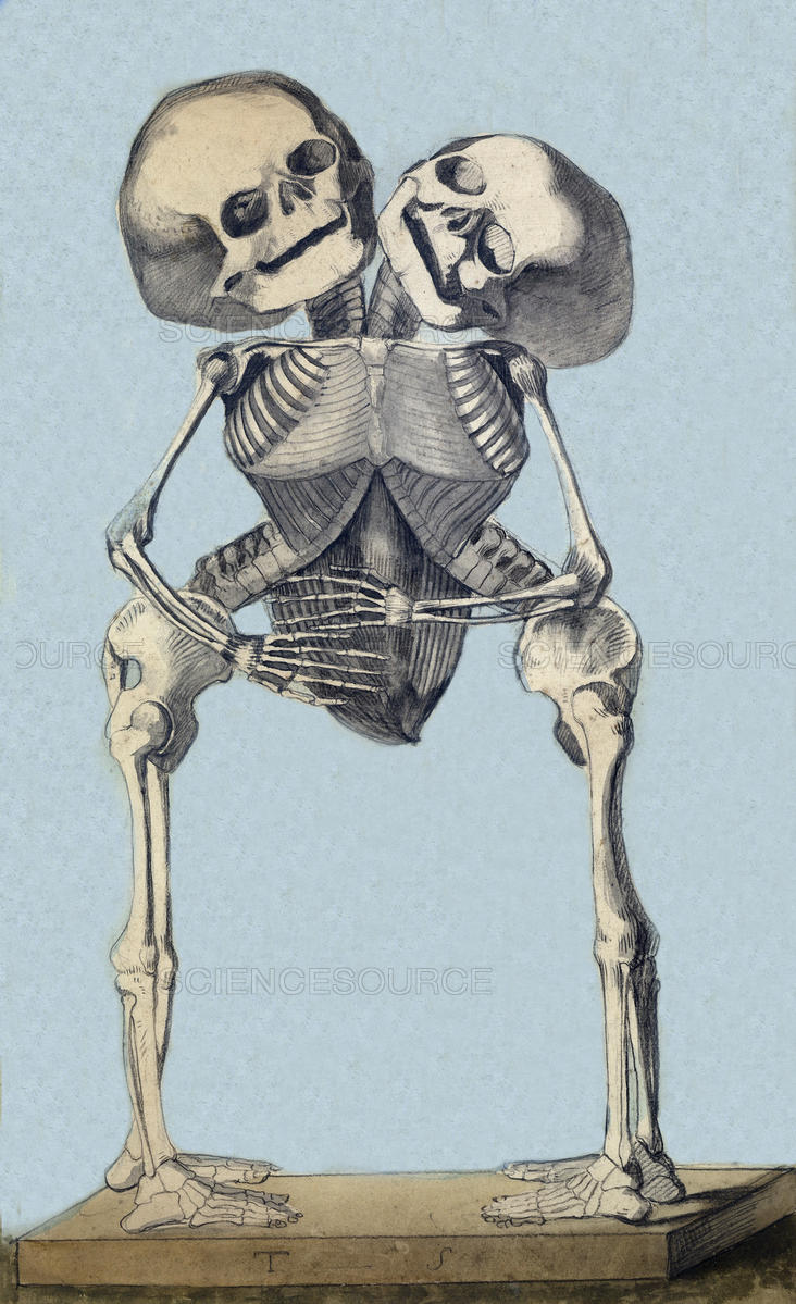 732x1199 Science Source - Siamese Twins Sketch