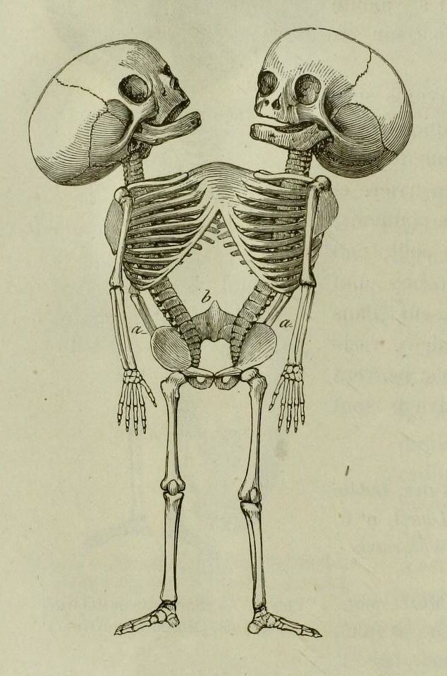 634x958 Sketch Of Conjoined Twins Tattoos Twins, Sketches - Siamese Twins Sketch