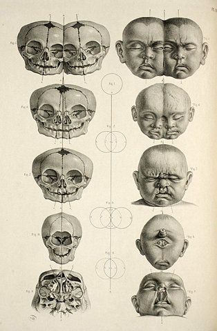 314x480 The Skeletal Anatomy Of Conjoined Twins Conjoined - Siamese Twins Sketch
