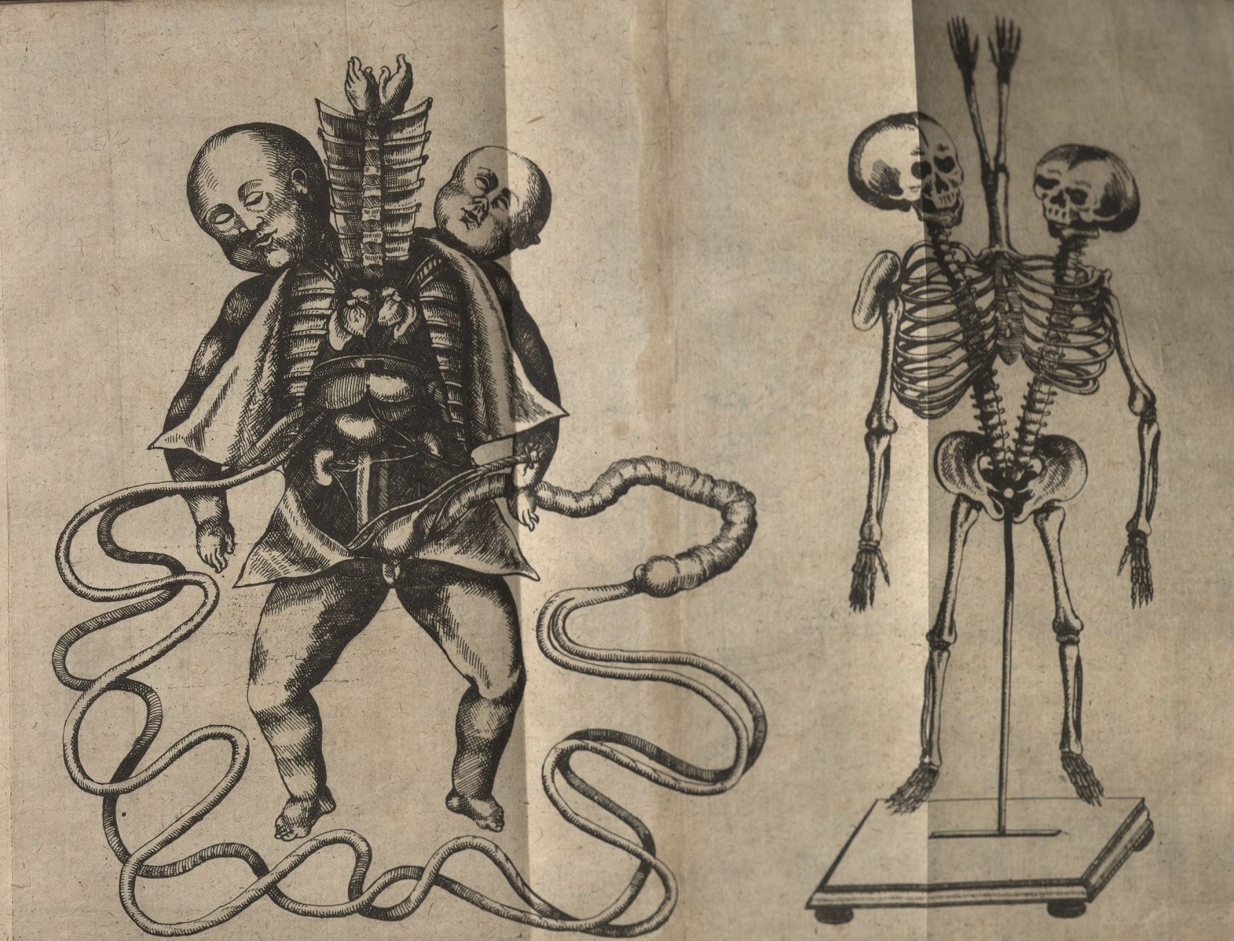 1794x1368 Conjoined Twins Houghton Library Blog - Siamese Twins Sketch