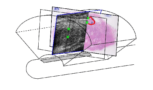 515x302 Left The Ultrasound And Annotated Pathology Images Are Segmented - Sketch 3d Surfaces