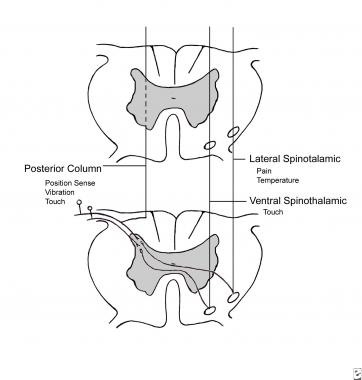 362x380 Spinal Cord Infarction Practice Essentials, Background - Spinal Cord Sketch