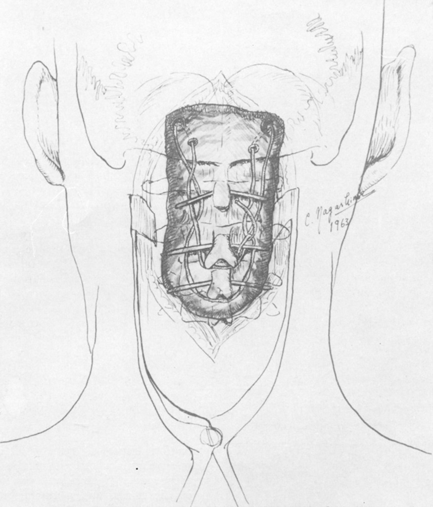 875x1024 The Use Of Acrylic Plastic For Vertebral Replacement Or Fixation - Spine Sketch