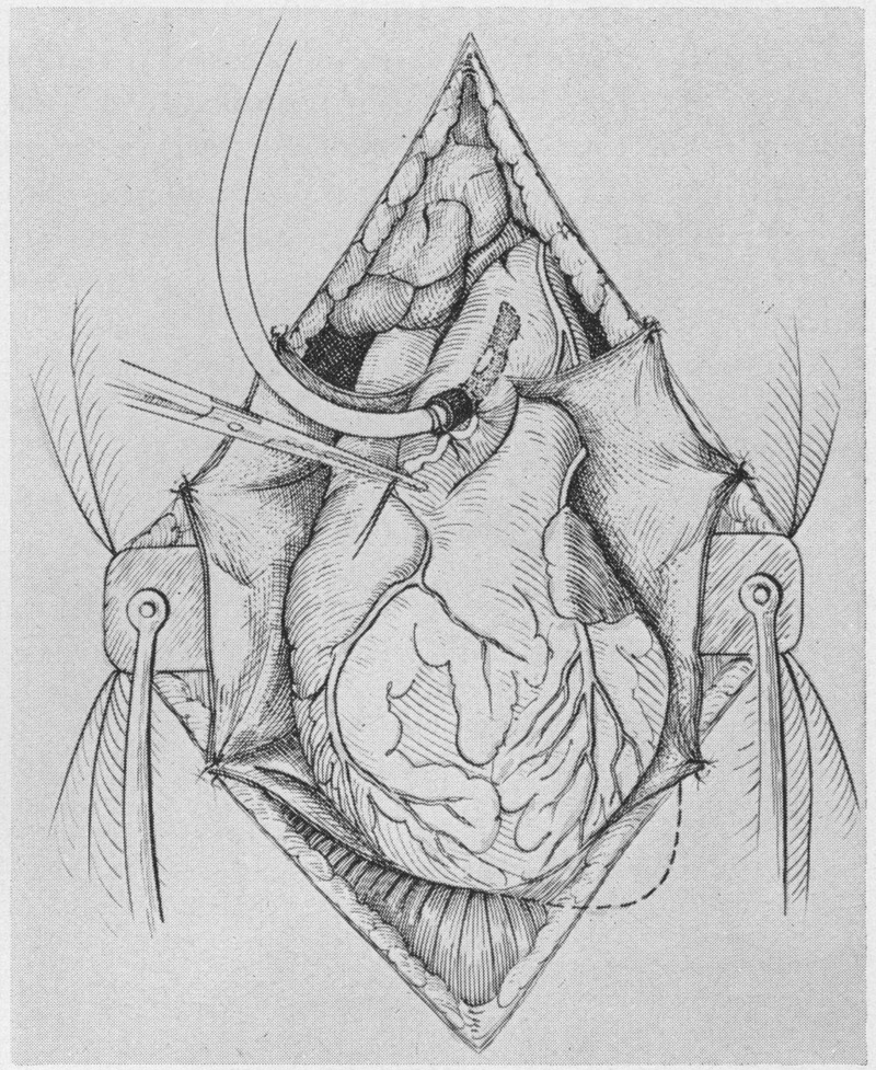 800x977 Hemodilution Perfusions For Open Heart Surgery Use Of Five Per - Surgery Sketch