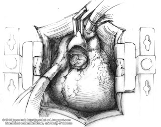 320x253 A R T . P O O P A G E Open Heart Surgery - Surgery Sketch