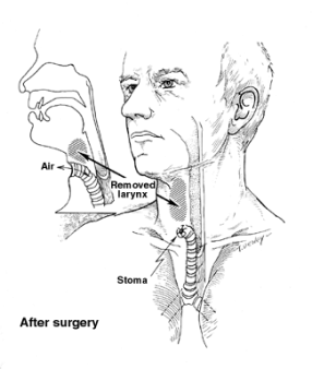 286x338 Surgery For Laryngeal And Hypopharyngeal Cancers - Throat Sketch