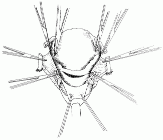 325x280 Mcpc - Uterus Sketch