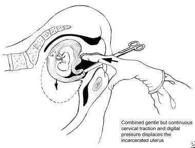 380x290 Malposition Of The Uterus Overview, Uterine Retroversion Or - Uterus Sketch