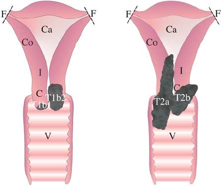 445x376 Sketch Of Cut Sections Of The Uterus Depicting All Tumor Stages - Uterus Sketch