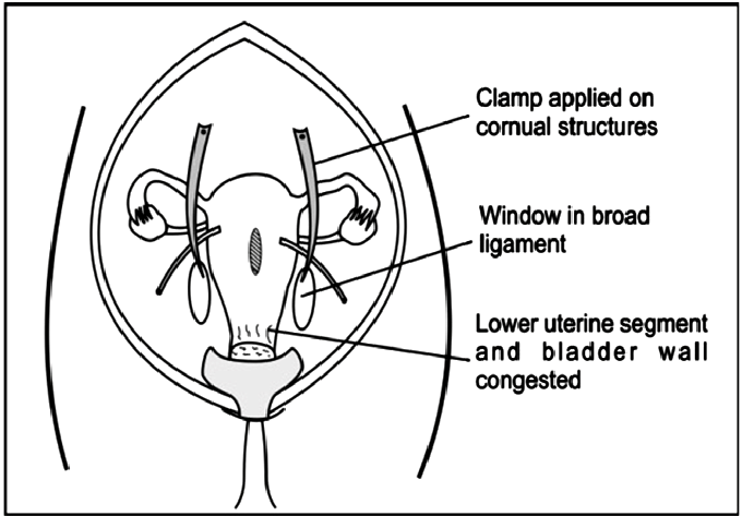 680x473 Sketch Showing The Creation Of 2 3 Cm Window In The Broad Ligament - Uterus Sketch