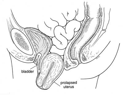 400x307 Treating Uterine Prolapse Without Surgery - Uterus Sketch